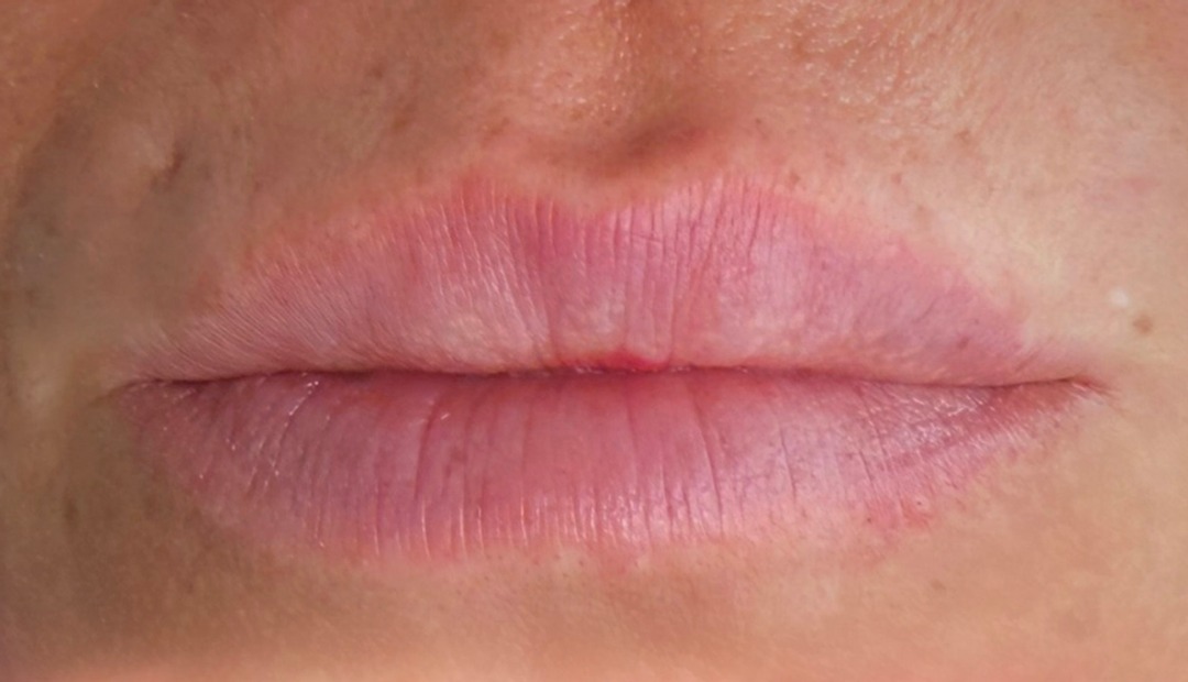 Antes de la micropigmentación de labios